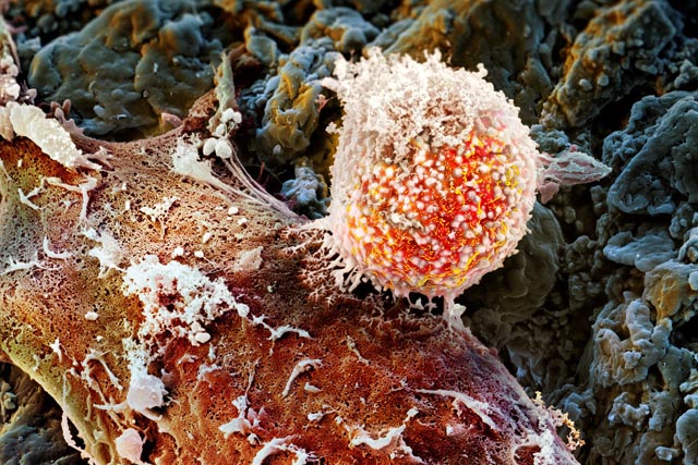 Unter der Lupe betrachtet: Interaktion zwischen einer Immunzelle und einer Tumorzelle. Laborbild: Universitätsspital Basel / Prof. Dr. med. Alfred Zippelius